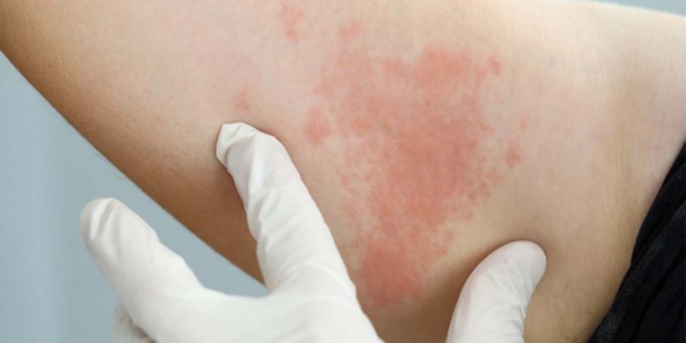 HIV ආසාදිතයන් හදිසියේම දෙගුණ වෙයි! අලුත් රෝගීන් අතර තරුණ ස්වාමින් වහන්සේලාත්!