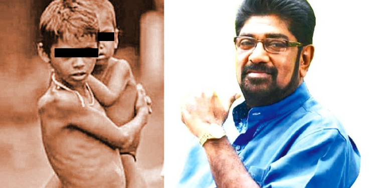 කෙහෙළිය ඡන්දෙ ඉල්ලපු දිස්ත්රික්කෙ එක පළාතක විතරක් මන්දපෝෂණය හැදුණු දරුවන් 400ක්! උග්ර මන්දපෝෂණයෙන් පෙළනෙ දරුවෝ 25ක්! Sri Lanka Latest News