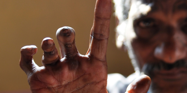 ලාදුරු රෝගීන් ගැන භයානක ආරංචියක්! Sri Lanka Latest News